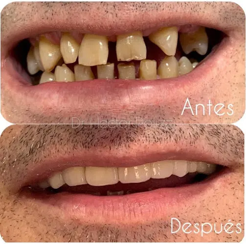 CLÍNICA DENTAL EN ALICANTE | HÉCTOR POLIZZI - Alicante